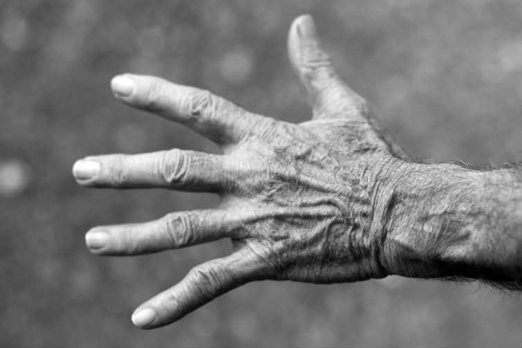 Mano artritis reumatoide Mano reumatoide