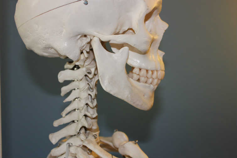 Síndrome de Klippel-Feil Sinostosis de Columna Cervical