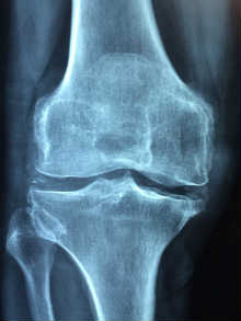 Espina de la Tibia fracturada Fractura Espina Tibial