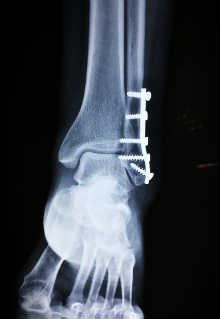 Fractura de tobillo