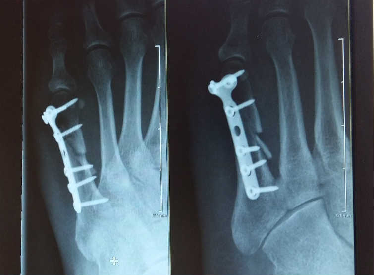 Fractura del metatarso