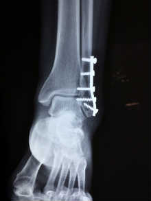 Fijación interna en fracturas Fracturas con fijación