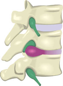 Hernia Clínica de Lumbalgia
