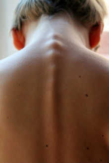 Hernia discal cervical